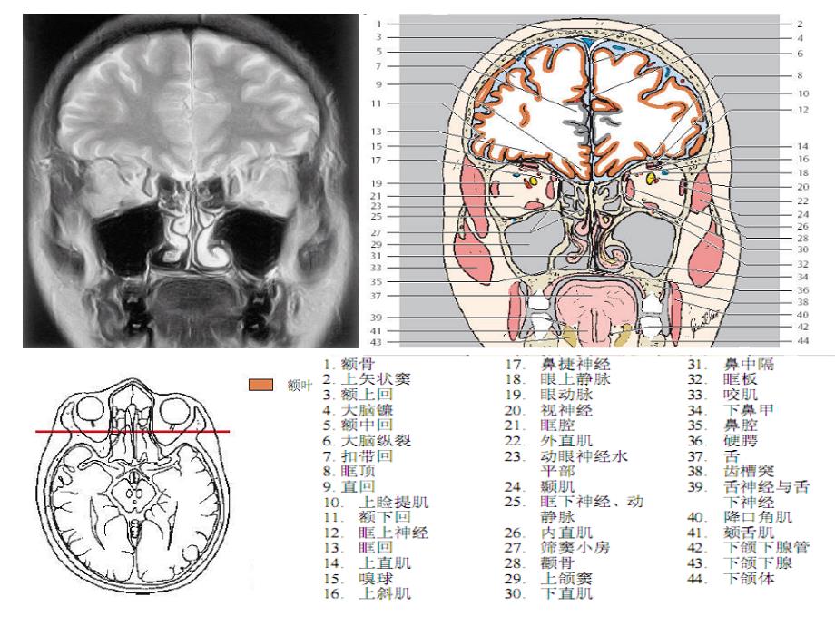 头颈ctmri解剖图解第四季_第3页