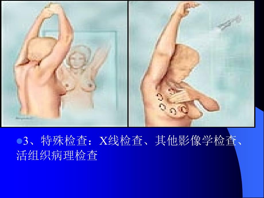 乳房疾病课件_1_第4页