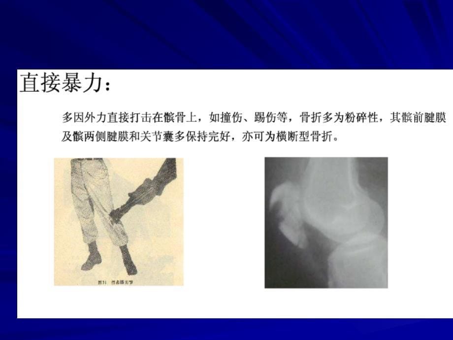 骨伤科护理学之下肢骨折概述_第5页
