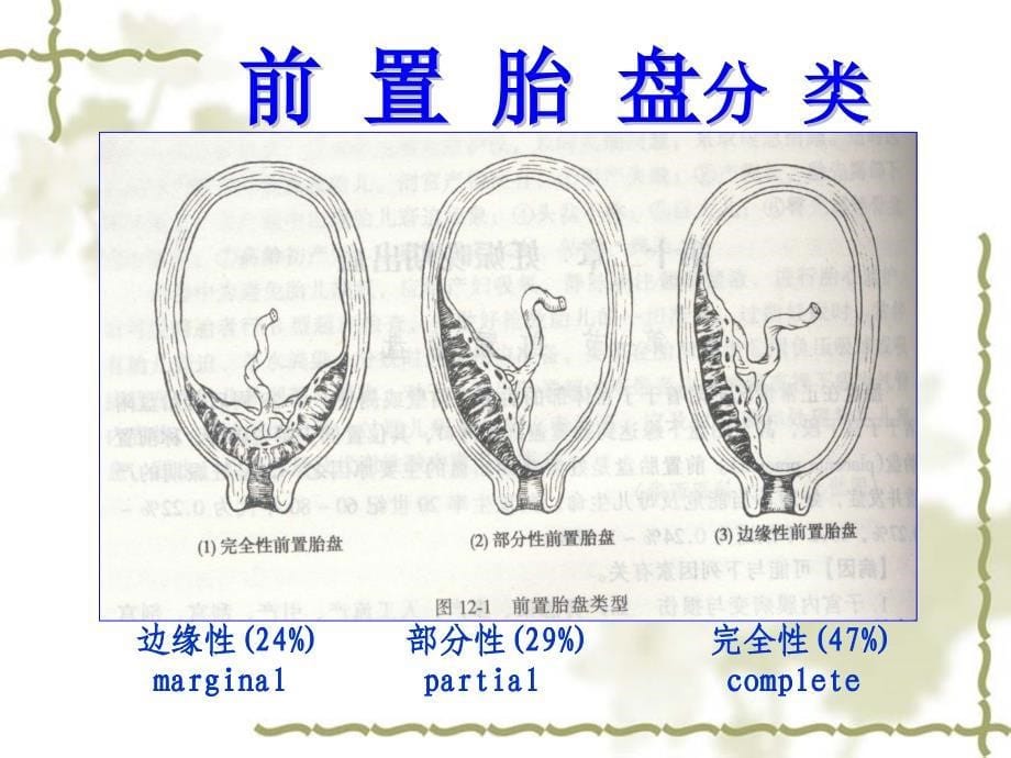 产前出血（妇产科基本知识培训课件）全套精篇_第5页