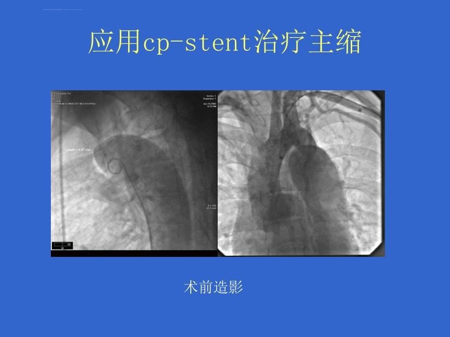 先心病介入治疗病历讨论ppt培训课件_第5页