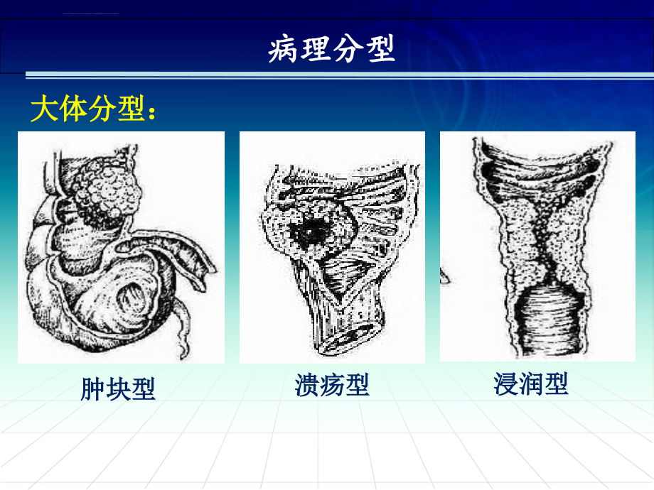 业务学习结直肠癌的护理ppt培训课件_第4页