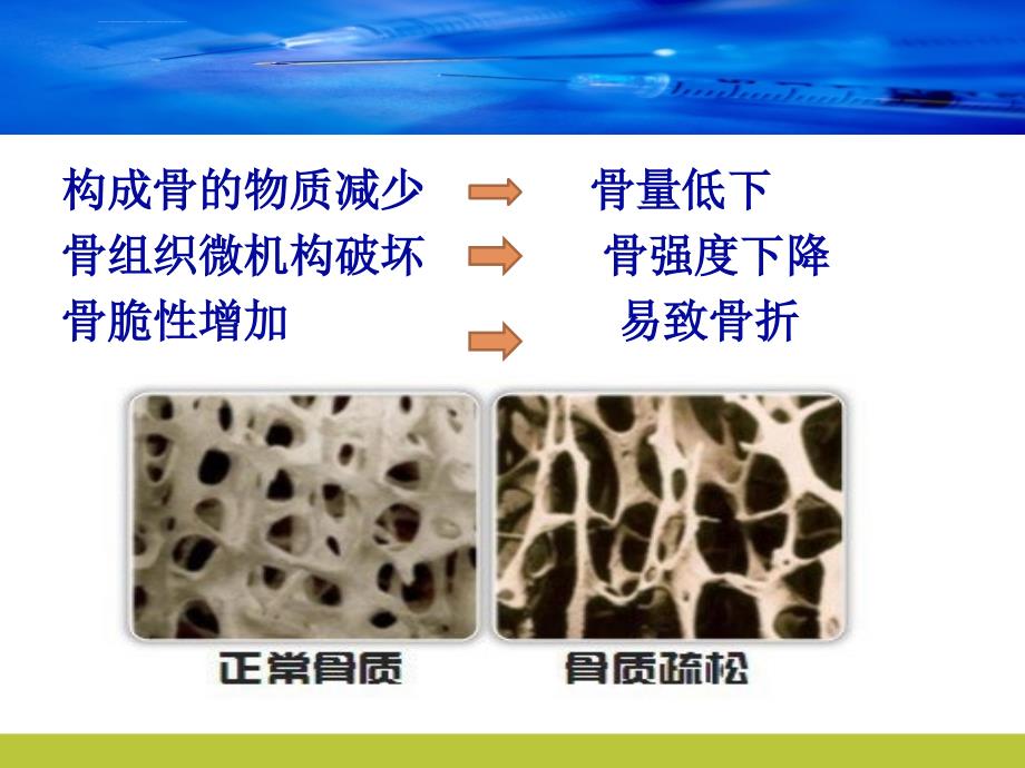 一例骨质疏松患者的护理查房报告ppt课件_第4页