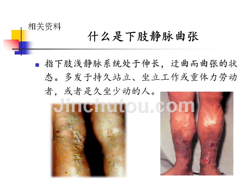 下肢静脉曲张的护理ppt培训课件_第3页