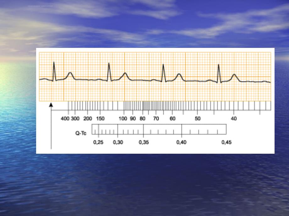 中国区国际心电图培训课程之典型病例ppt培训课件_第3页