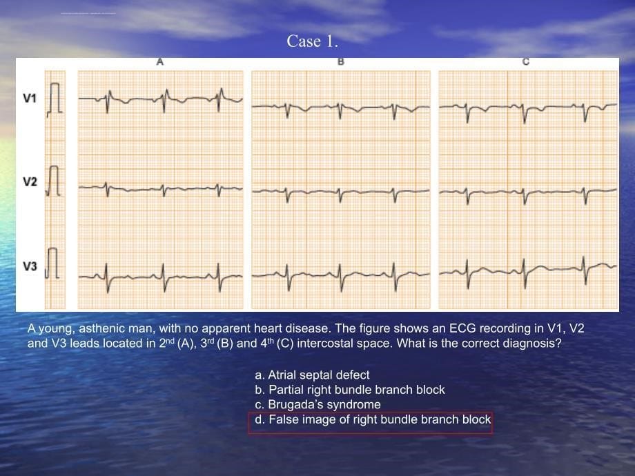 中国区国际心电图培训课程之典型病例ppt培训课件_第5页