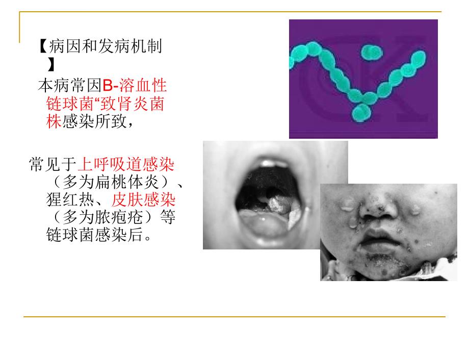 急性肾小球肾炎ppt课件_第2页