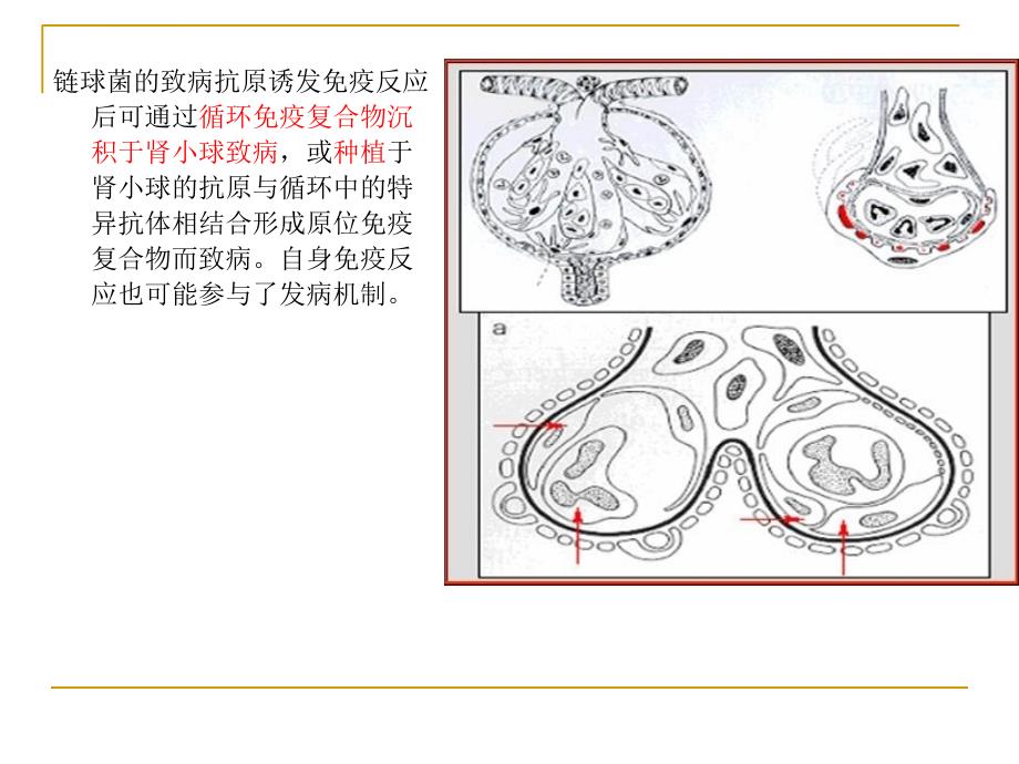 急性肾小球肾炎ppt课件_第3页