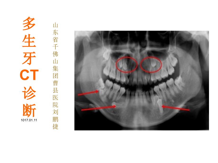 多生牙ct诊断ppt课件_第1页