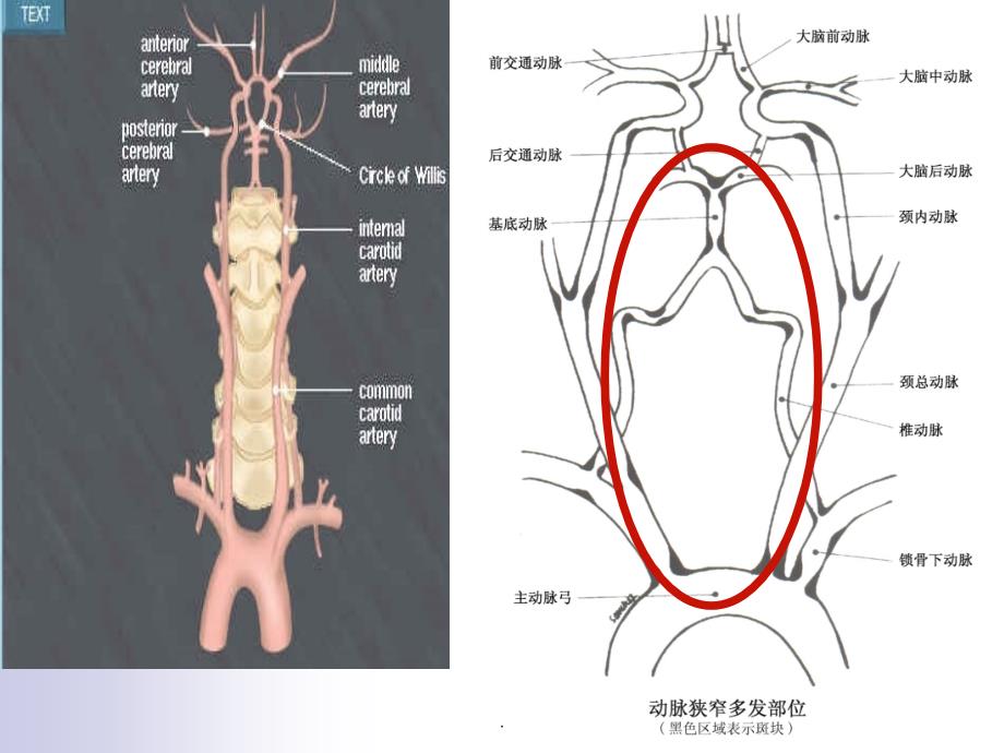 后循环缺血专家共识ppt课件_第3页