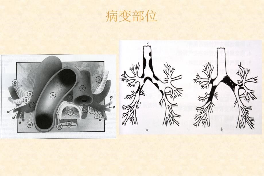 气道内激光消融术_第5页