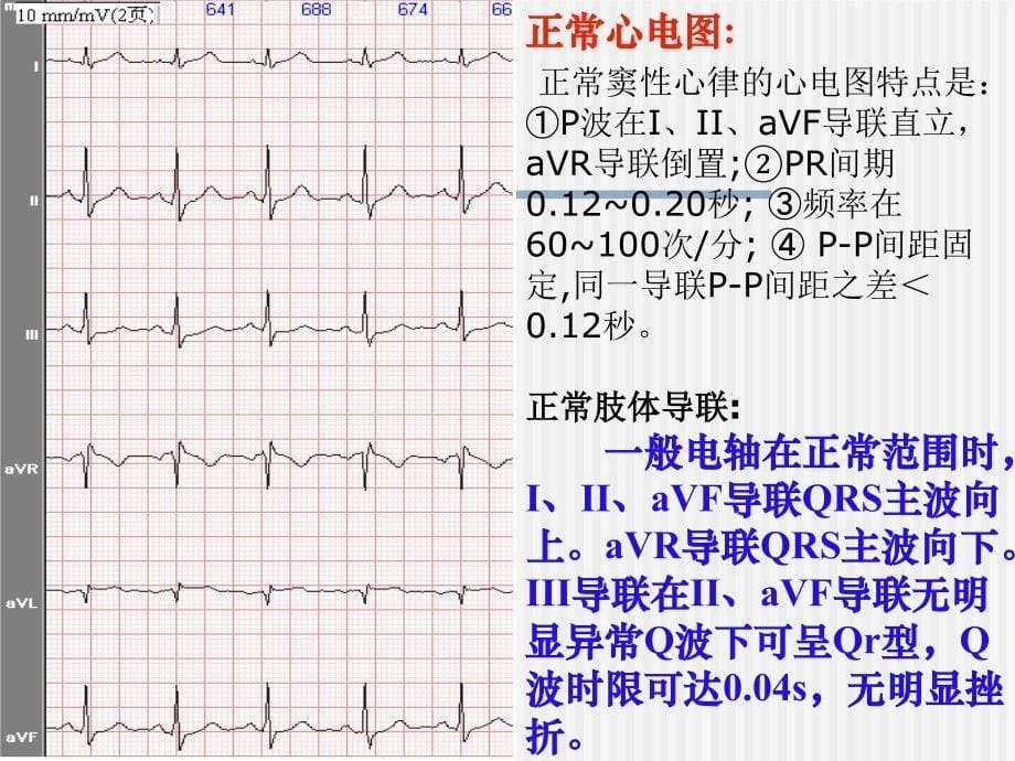 心电图的基础知识及常见异常心电图识别ppt课件_第5页