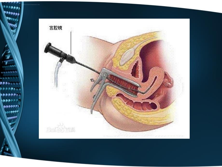 宫腔镜术后护理ppt课件_第2页