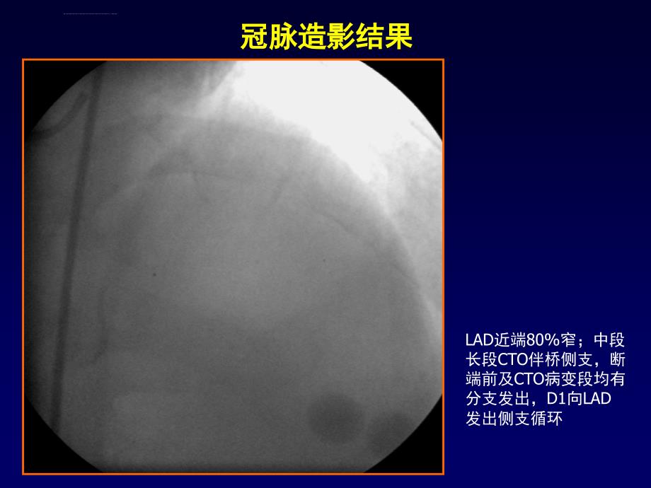 慢性完全闭塞病变介入治疗(cto)典型病例报告-韩雅玲_第3页