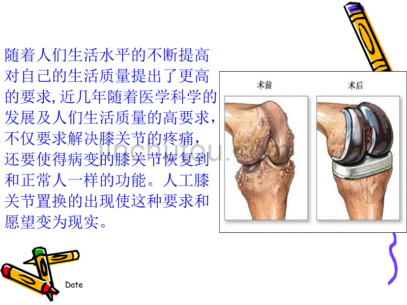 人工膝关节置换适应症及术前最佳状态_第2页