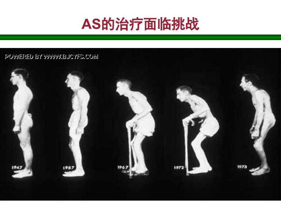 益赛普治疗强直性脊柱炎ppt课件_第2页