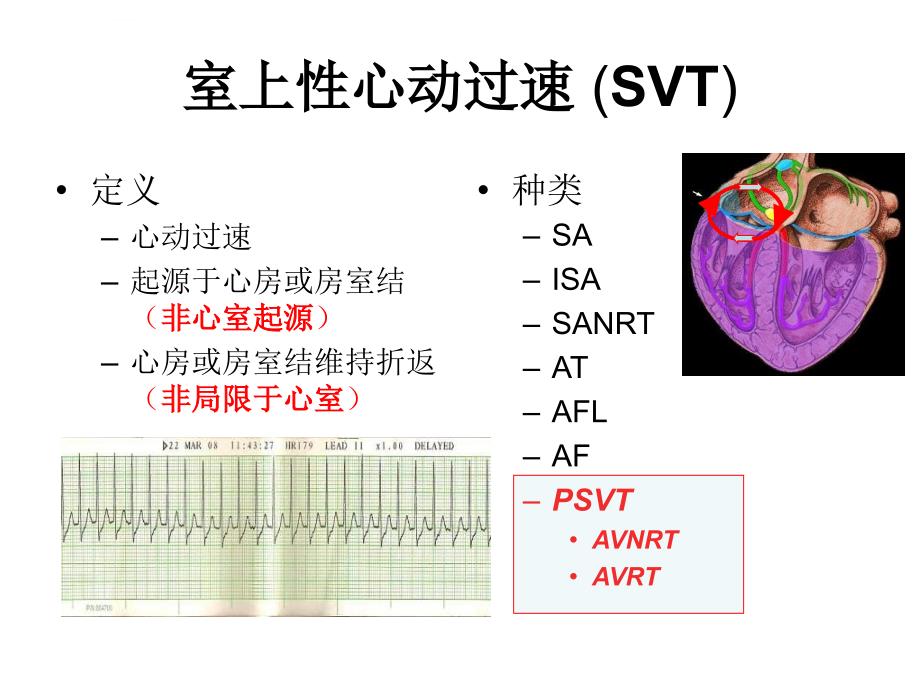 特殊类型室上速的消融进展ppt培训课件_第2页