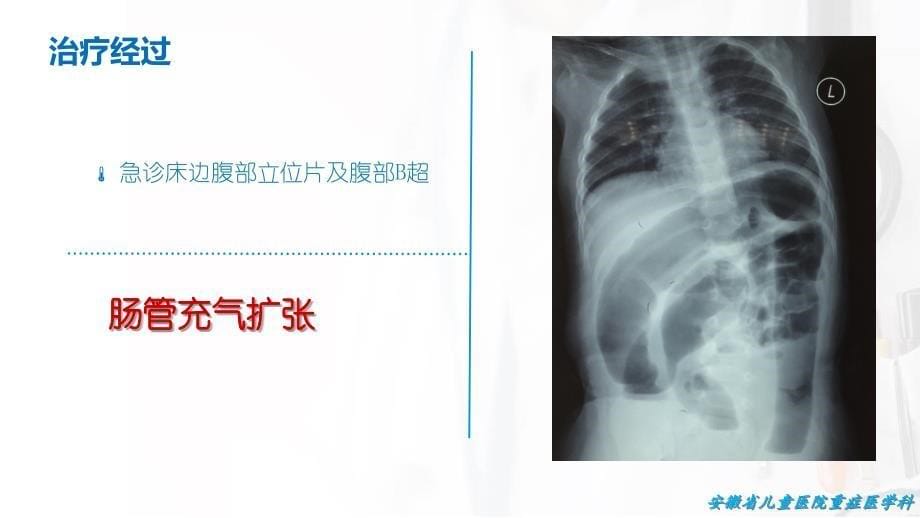 溃疡性结肠炎ppt课件_第5页