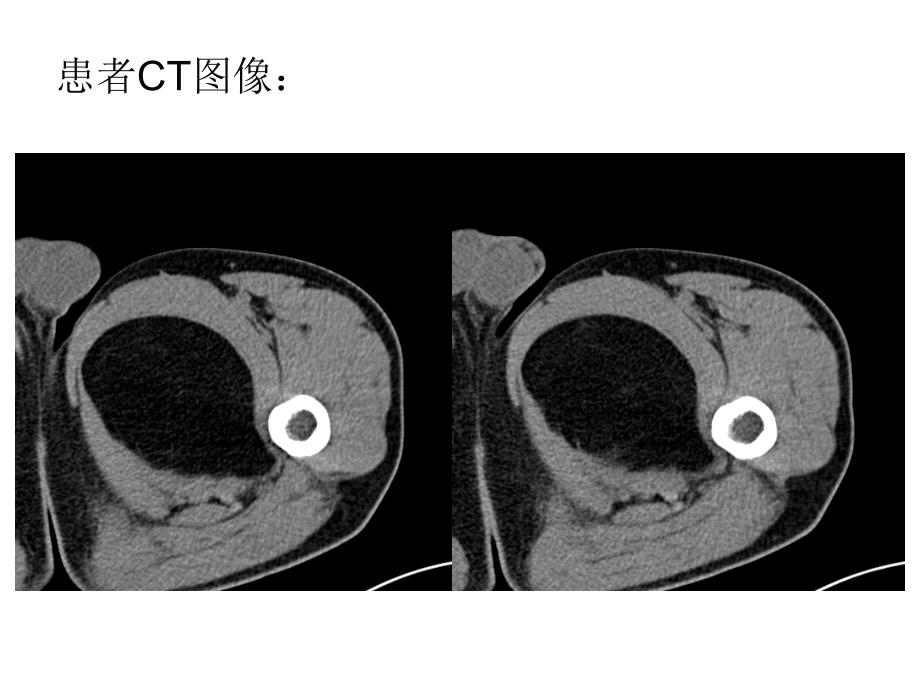 棕色脂肪瘤与棕色瘤ppt课件_第4页