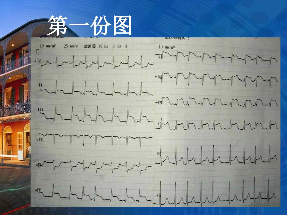 急性下壁心梗pci术后反复室速一例ppt培训课件_第4页