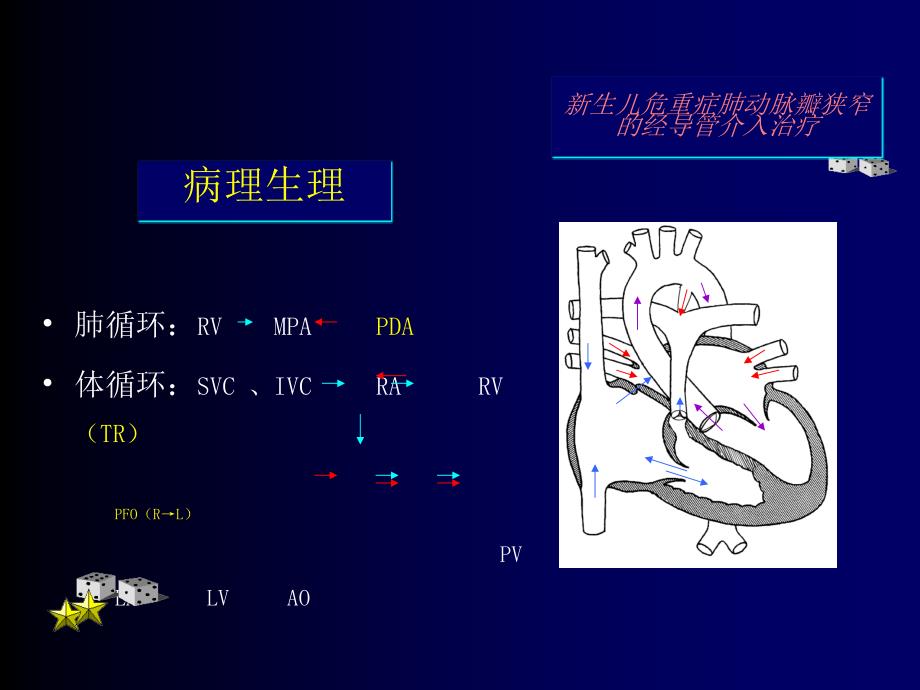 新生儿危重症肺动脉瓣狭窄的经导管介入治疗_第3页