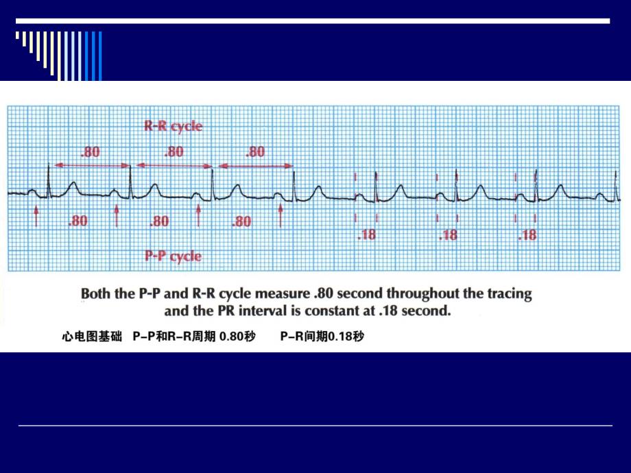 常见心律失常的心电图诊断_第2页