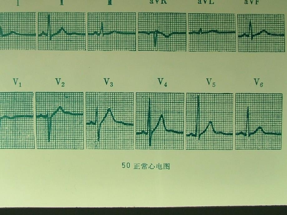 常见心律失常的心电图诊断_第3页