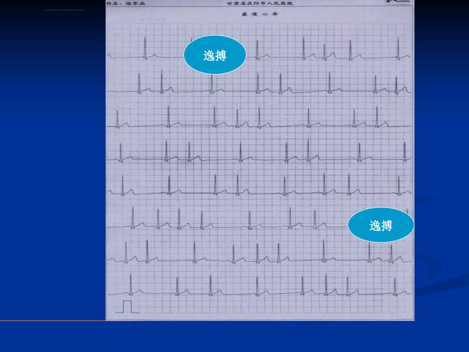 房速快慢综合征_李学奇_第4页