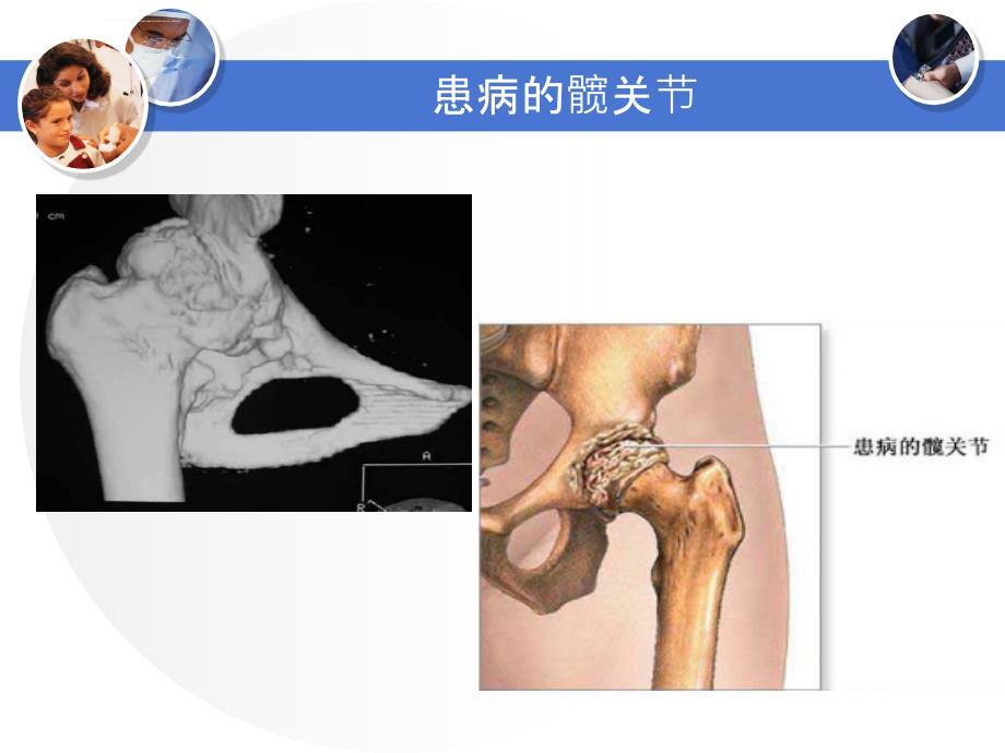 髋关节置换术后护理ppt课件_第4页