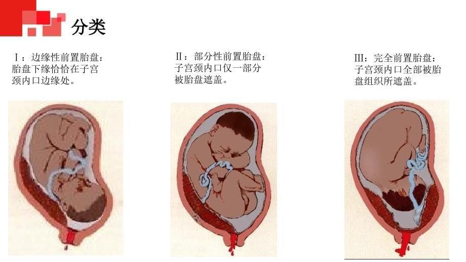 前置胎盘的护理查房ppt课件_第5页