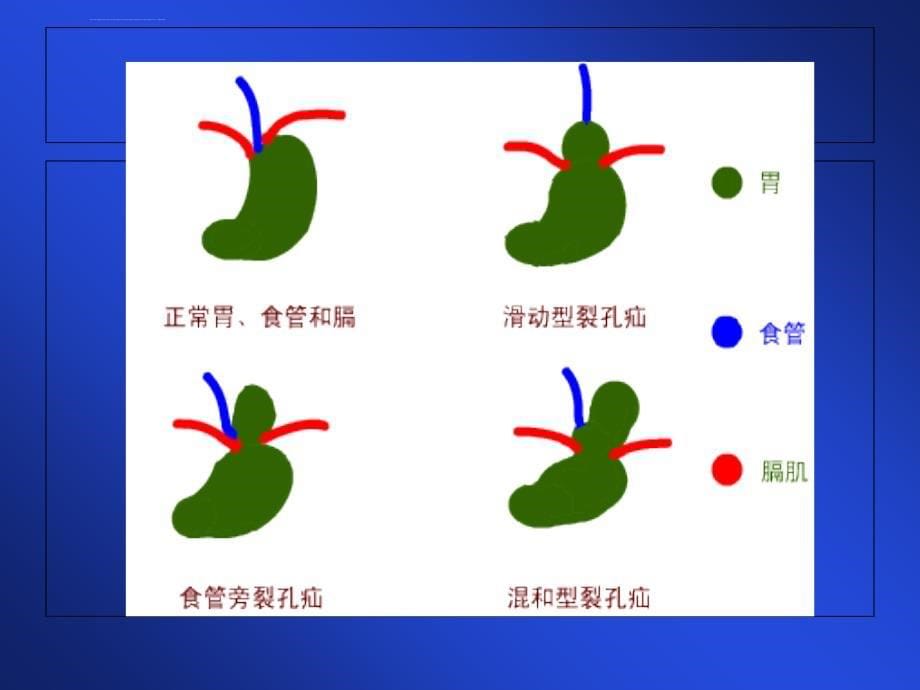 食管裂孔疝ppt培训课件_第5页