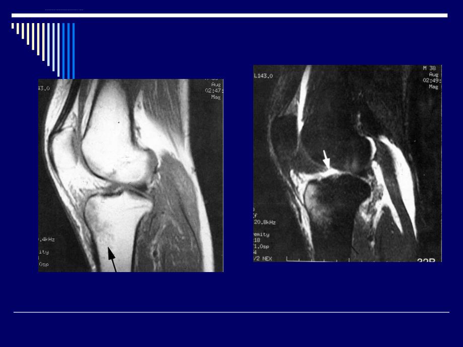 膝关节的mri诊断ppt课件_第3页