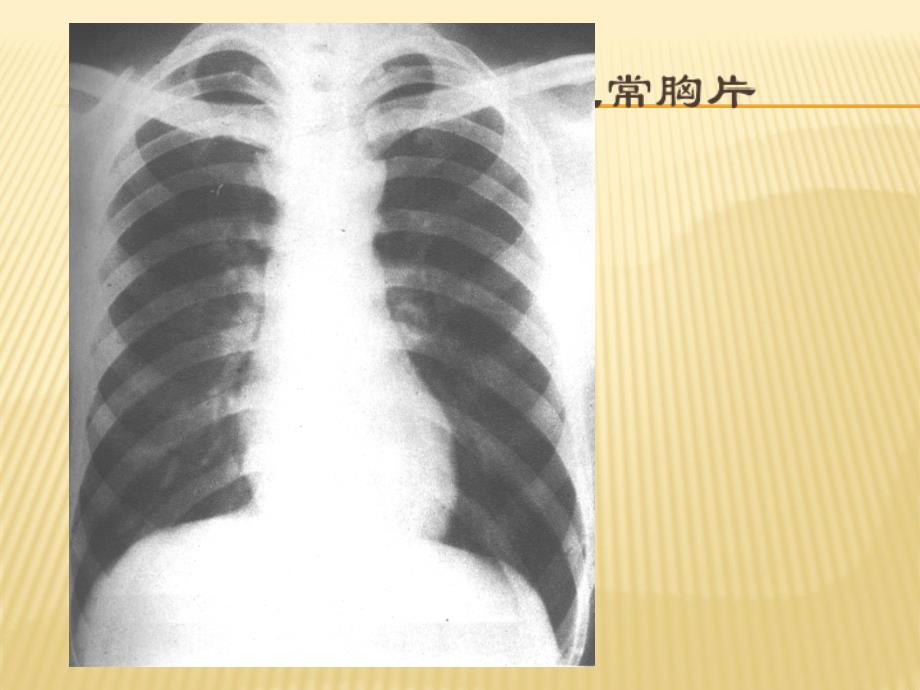 胸部x线诊断ppt课件_第4页