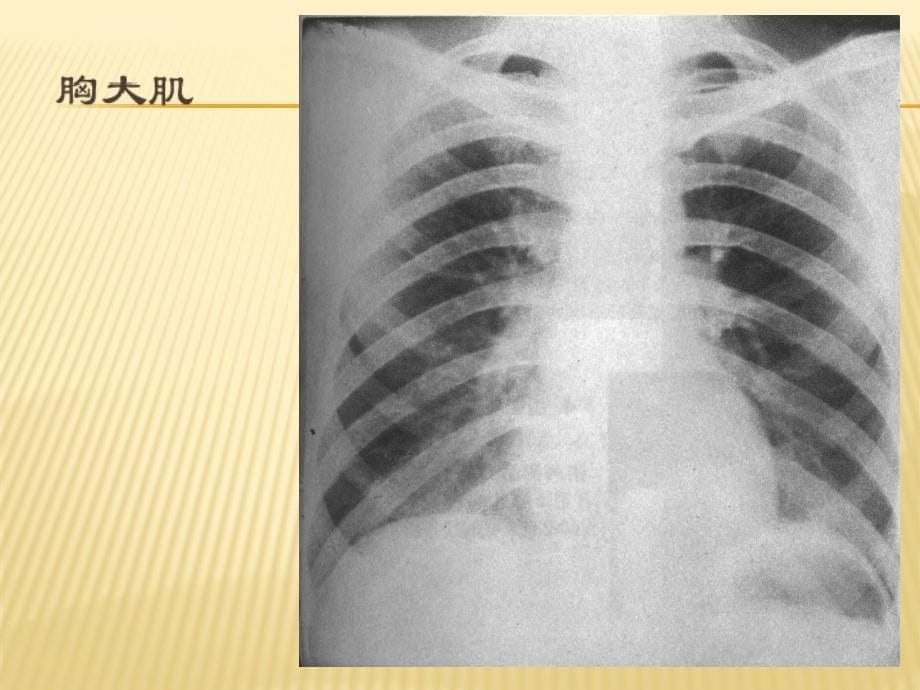 胸部x线诊断ppt课件_第5页