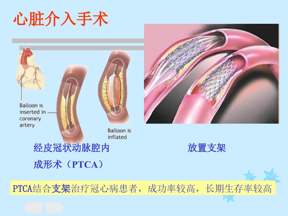 缺血再灌注损伤医学课件_第2页