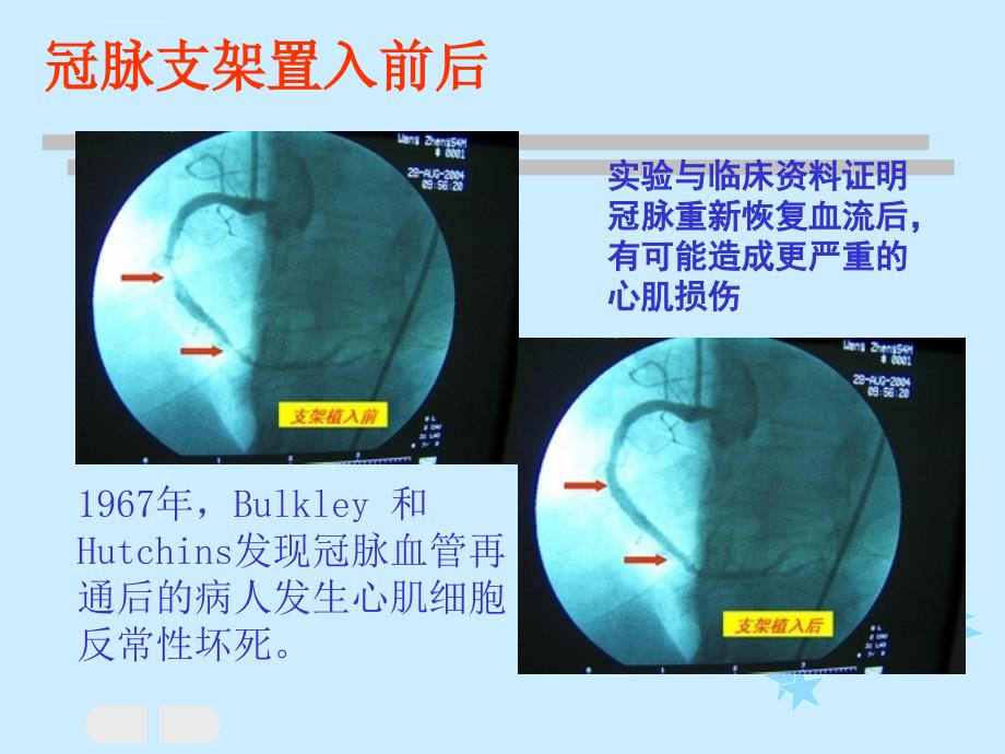 缺血再灌注损伤医学课件_第3页