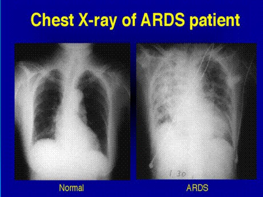 及ards课件课件_第2页
