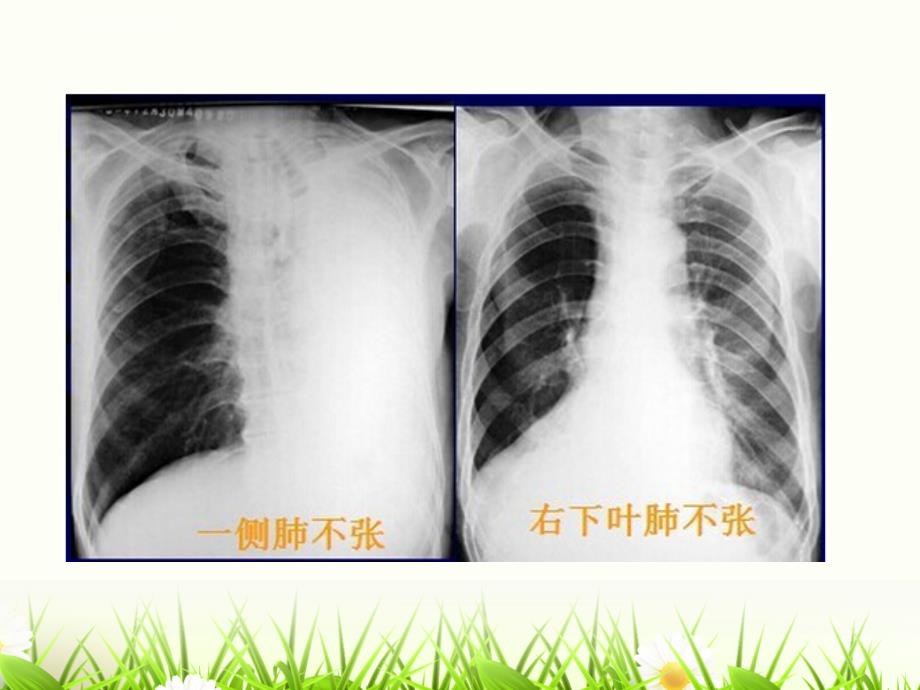 肺部常见病变的x线片总结课件_第4页