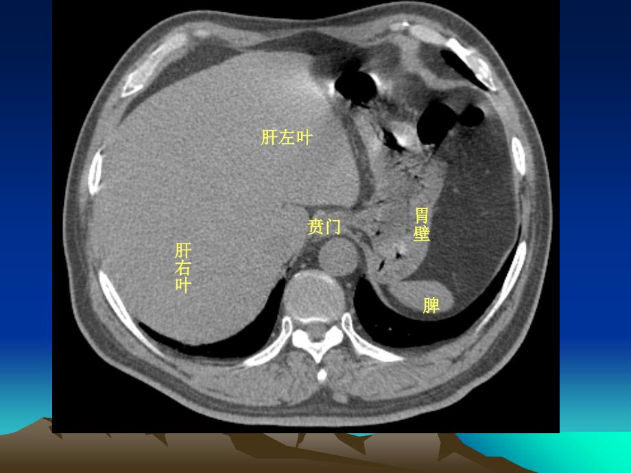 腹部影像解剖课件_第3页