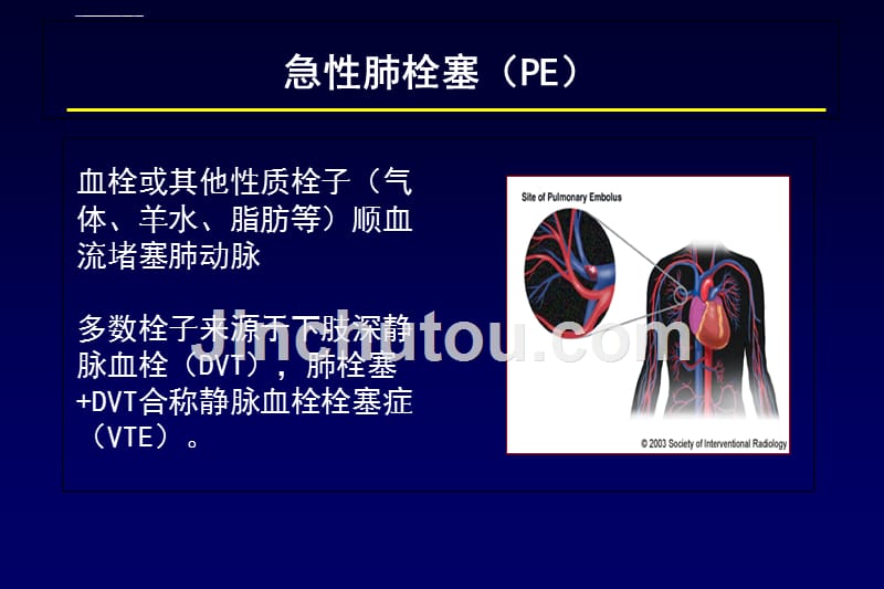 肺栓塞诊断及鉴别诊断ppt课件_第2页