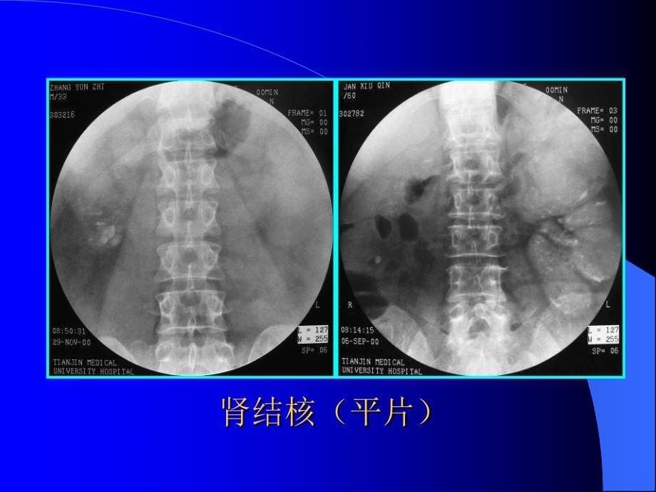 影像诊断学（肾结核）_第5页