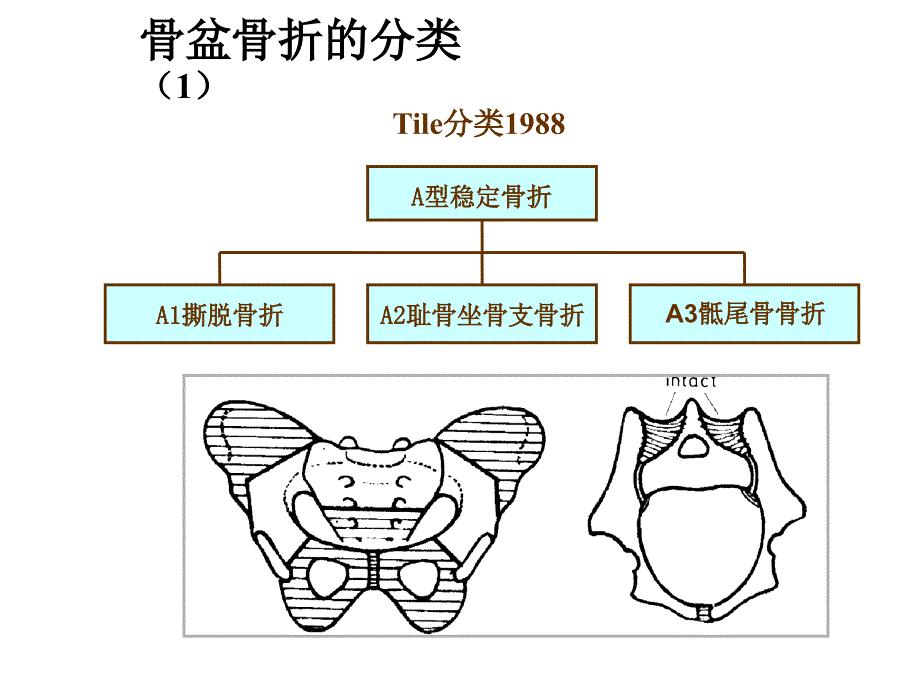 骨盆损伤课件_第3页