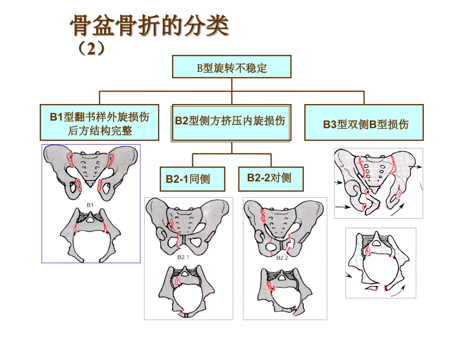 骨盆损伤课件_第4页