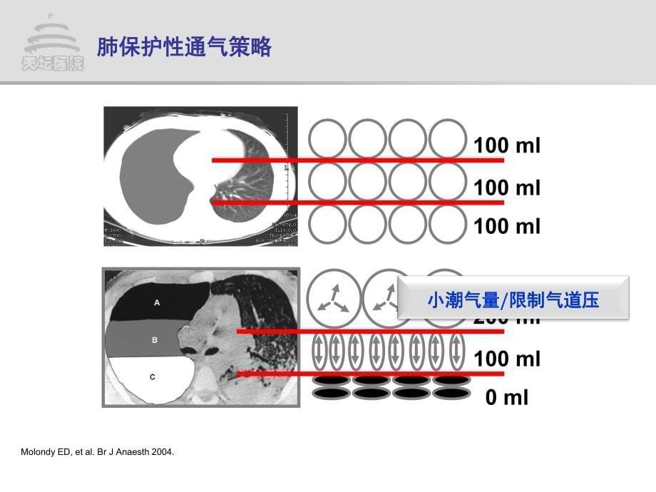 脑损伤患者的肺保护性通气策略-周建新_第5页