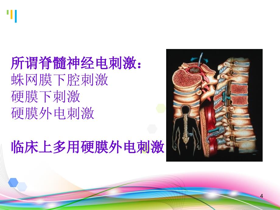 脊髓电刺激PPT课件_第4页