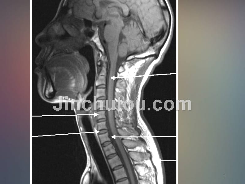 脊髓和椎管内疾病MR诊断PPT课件_第3页