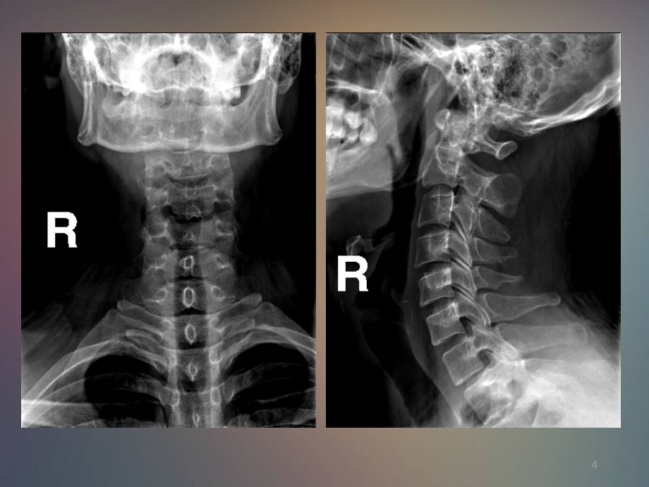 脊柱病变影像表现PPT课件_第4页