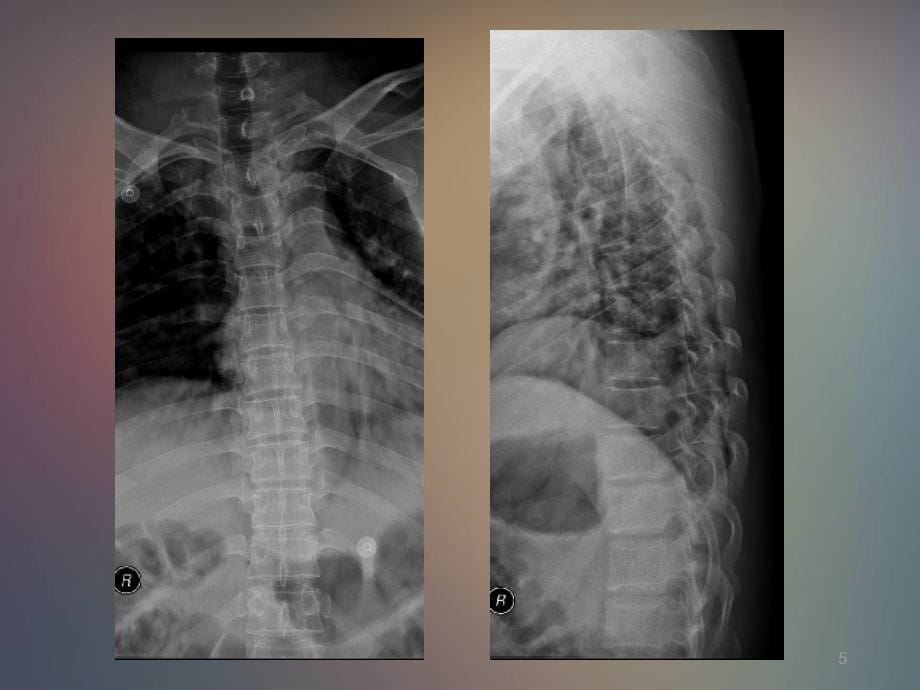 脊柱病变影像表现PPT课件_第5页