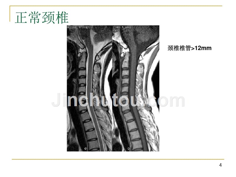 脊柱脊髓MRI诊断PPT课件_第4页