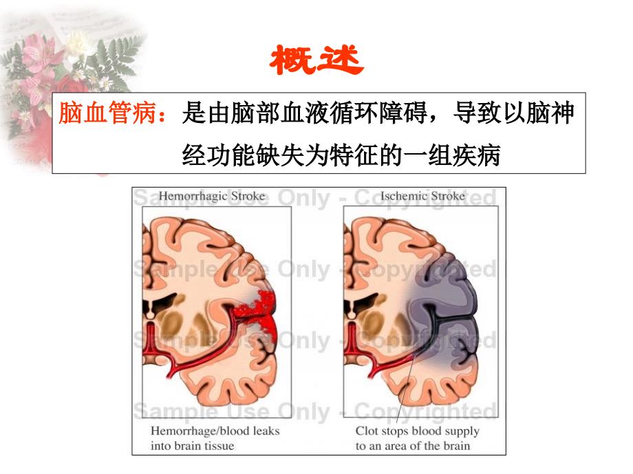 缺血性脑血管病脑梗塞ppt课件_第2页